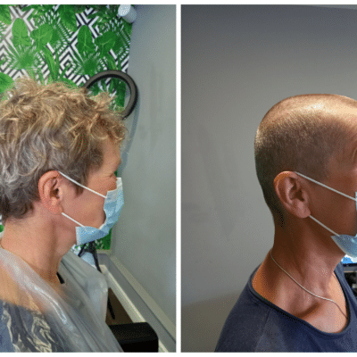 A before and after of Janet with and without hair.